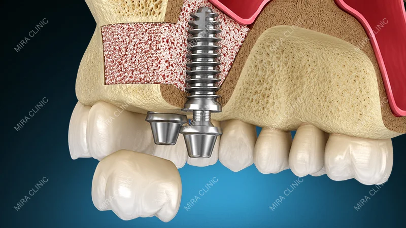 Sinus Lifts